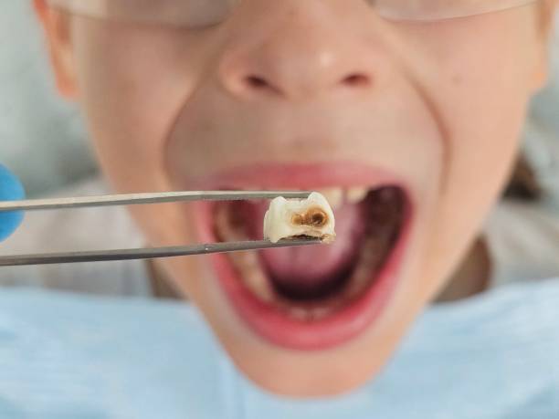 Best Emergency Tooth Extraction in Alturas, FL